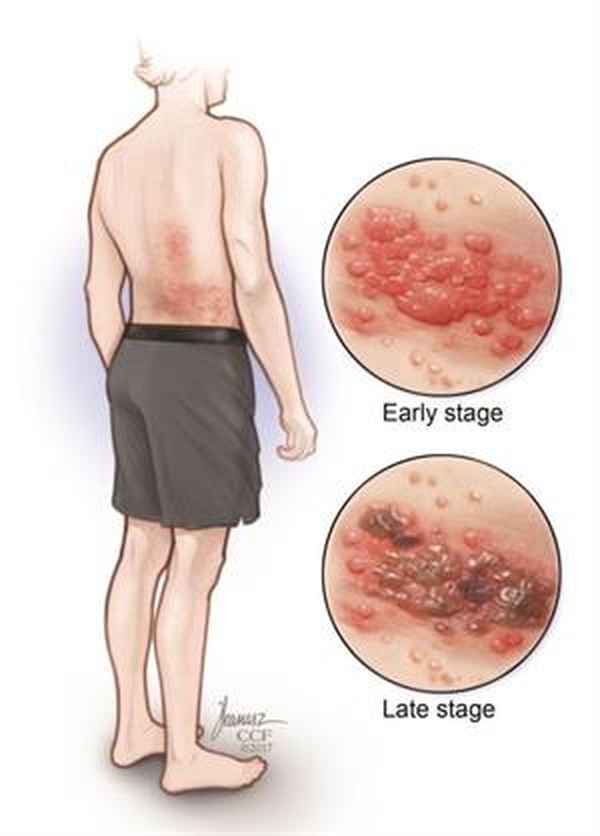 Pengobatan penyakit Herpes zoster di Penang dengan dokter kulit yang berpengalaman - MediSehat
