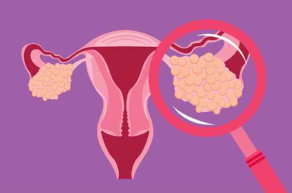 Kanker ovarium adalah kanker yang berasal dari jaringan ovarium atau indung telur.