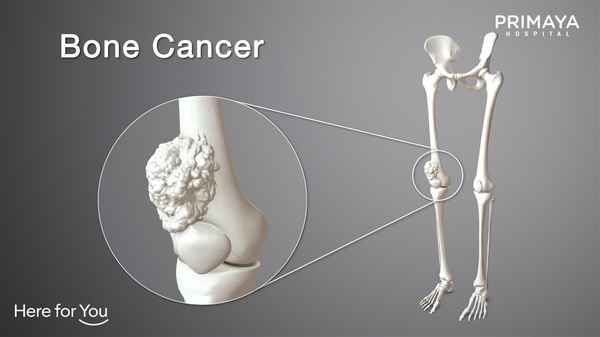 kanker tulang, dokter penang biasa menangani jenis kanker tulang. yang paling umum dialami orang dewasa dan kanak-kanak
