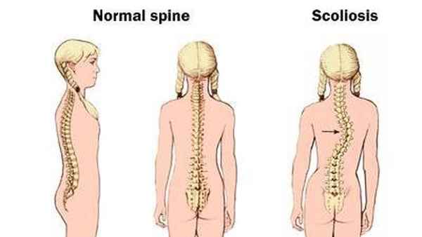 dokter tulan belakang, koliosis: Merupakan kelainan postur tulang belakang yang menyebabkan lengkungan abnormal pada tulang belakang. Skoliosis dapat berkembang pada masa pertumbuhan dan mempengaruhi postur tubuh.