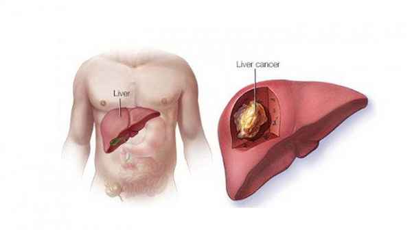 Kanker hati, yang juga dikenal sebagai kanker hepatoseluler- pengobatan Kanker Hati di Penang