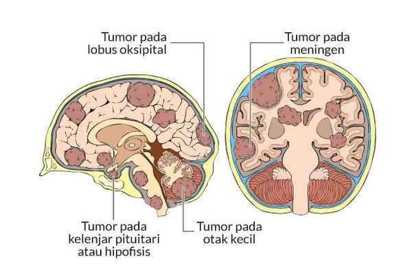 Dokter kanker Hipofisis di penang biasa menangani kanker Hipofisis jenis tumor yang terbentuk di kelenjar pituitari di otak.