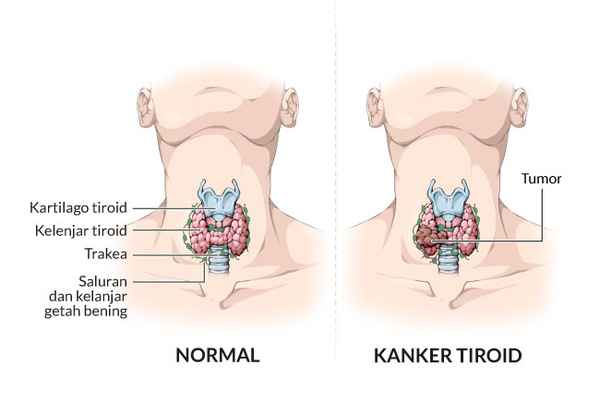perbedaan trakea normal dan terkena kanker tiroid, banyak pesakit yang berobat ke penang soal kanker ini.