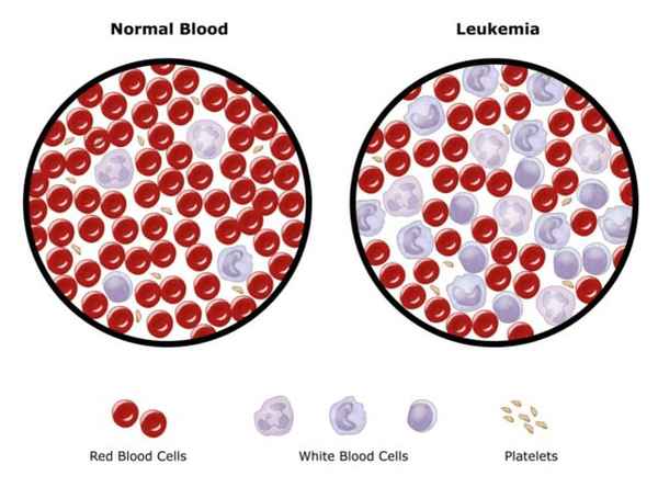 kanker onkologi darah leukemia, limfoma dokter haematologi kanker di penang