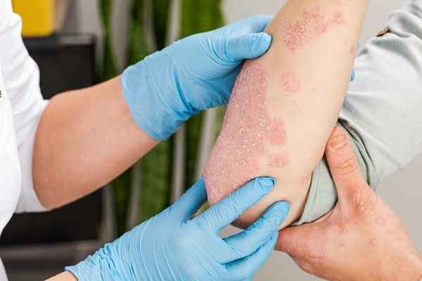 Penyakit kulit adalah kelainan kulit yang diakibat adanya jamur, kuman, parasit, virus maupun infeksi yang dapat menyerang siapa saja